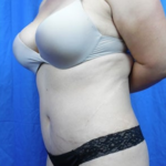 Tummy Tuck Before & After Patient #9200