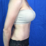 Tummy Tuck Before & After Patient #9207