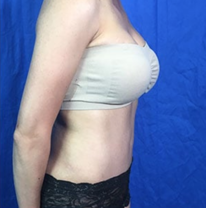 Tummy Tuck Before & After Patient #9207