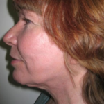 Facelift and Necklift Before & After Patient #9104