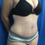 Tummy Tuck Before & After Patient #9223