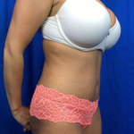 Tummy Tuck Before & After Patient #9228