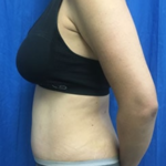 Tummy Tuck Before & After Patient #9233