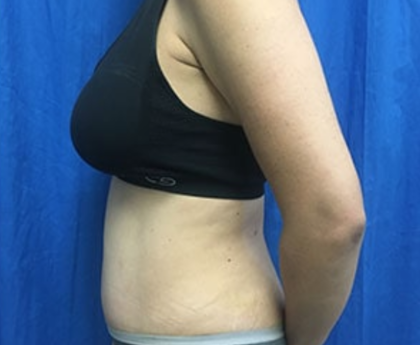 Tummy Tuck Before & After Patient #9233