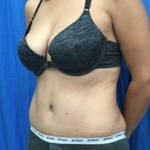 Tummy Tuck Before & After Patient #9238