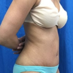 Tummy Tuck Before & After Patient #9243