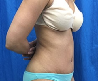 Tummy Tuck Before & After Patient #9243