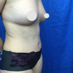 Tummy Tuck Before & After Patient #9257