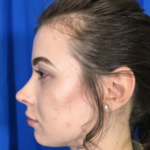 Rhinoplasty Before & After Patient #9141