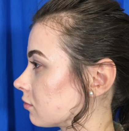 Rhinoplasty Before & After Patient #9141