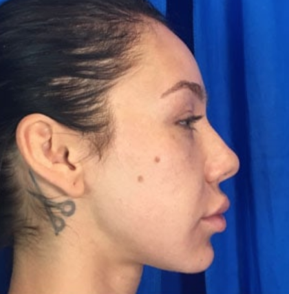 Rhinoplasty Before & After Patient #9111