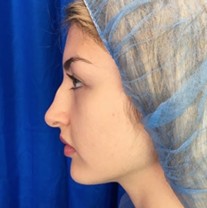 Rhinoplasty Before & After Patient #9186