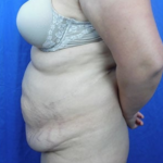 Tummy Tuck Before & After Patient #9200