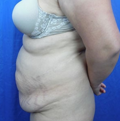 Tummy Tuck Before & After Patient #9200