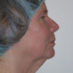 Facelift and Necklift Before & After Patient #9104