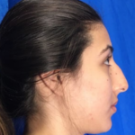 Rhinoplasty Before & After Patient #9118