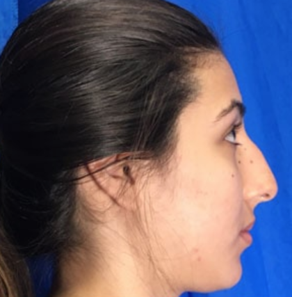 Rhinoplasty Before & After Patient #9118