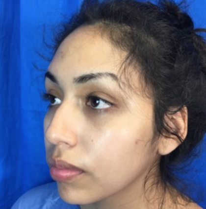 Rhinoplasty Before & After Patient #9132