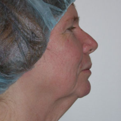 Facelift and Necklift Before & After Patient #9104