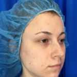 Rhinoplasty Before & After Patient #9141