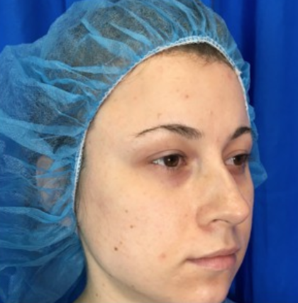 Rhinoplasty Before & After Patient #9141