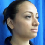 Rhinoplasty Before & After Patient #9153