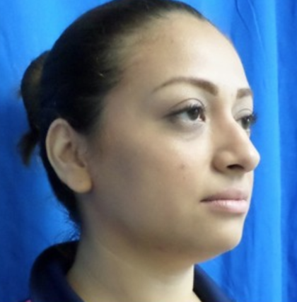 Rhinoplasty Before & After Patient #9153