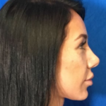 Rhinoplasty Before & After Patient #9111