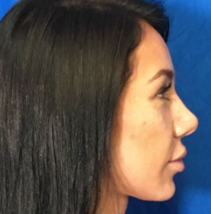 Rhinoplasty Before & After Patient #9111