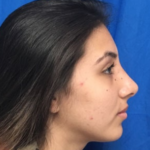 Rhinoplasty Before & After Patient #9118