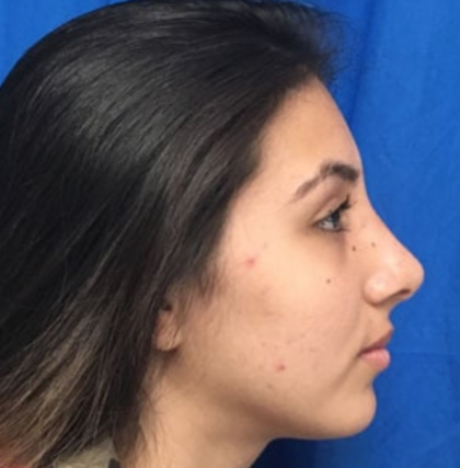 Rhinoplasty Before & After Patient #9118