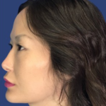 Rhinoplasty Before & After Patient #9125