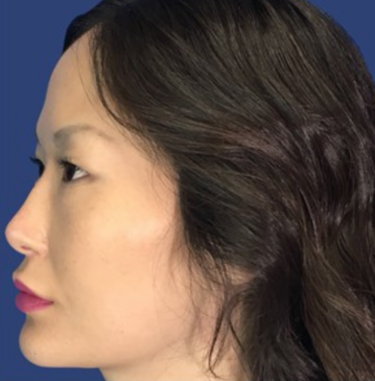 Rhinoplasty Before & After Patient #9125