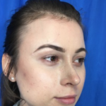 Rhinoplasty Before & After Patient #9141