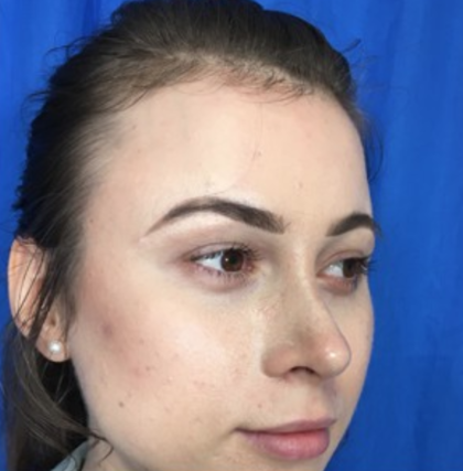 Rhinoplasty Before & After Patient #9141