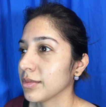 Rhinoplasty Before & After Patient #9179