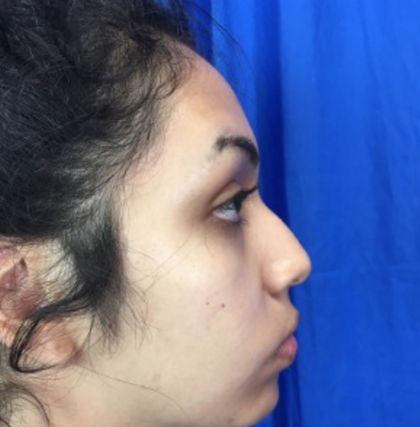 Rhinoplasty Before & After Patient #9132