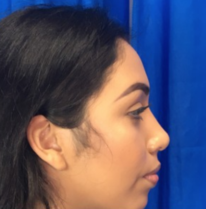 Rhinoplasty Before & After Patient #9132