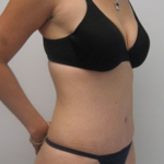 Tummy Tuck Before & After Patient #9250