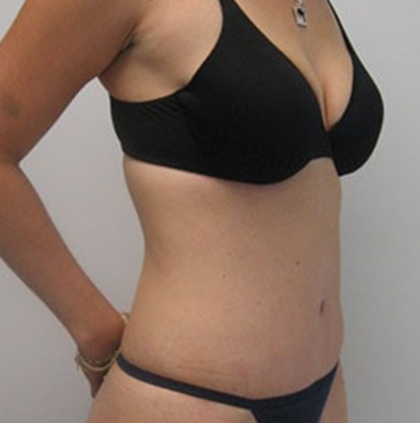 Tummy Tuck Before & After Patient #9250