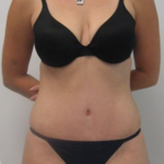 Tummy Tuck Before & After Patient #9250