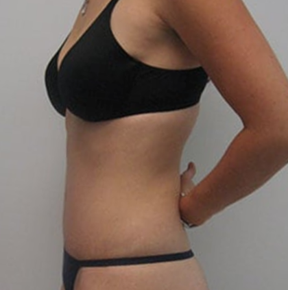 Tummy Tuck Before & After Patient #9250