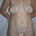 Tummy Tuck Before & After Patient #9250