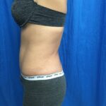 Tummy Tuck Before & After Patient #9238