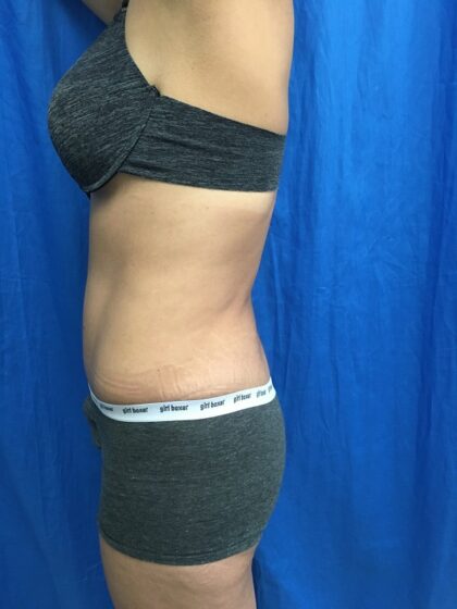 Tummy Tuck Before & After Patient #9238