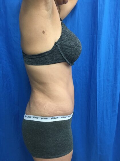 Tummy Tuck Before & After Patient #9238