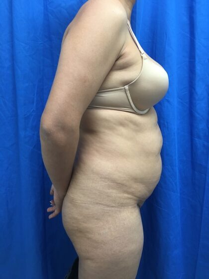 Tummy Tuck Before & After Patient #9238