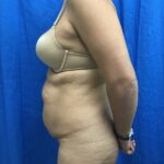 Tummy Tuck Before & After Patient #9238