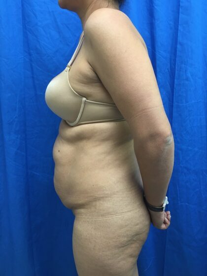 Tummy Tuck Before & After Patient #9238