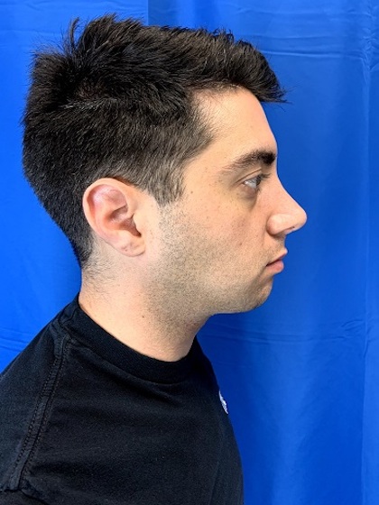 Rhinoplasty Before & After Patient #9382